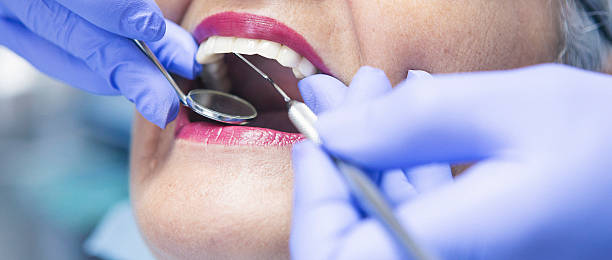Best Emergency Dental Care for Broken or Chipped Teeth in Oswego, NY